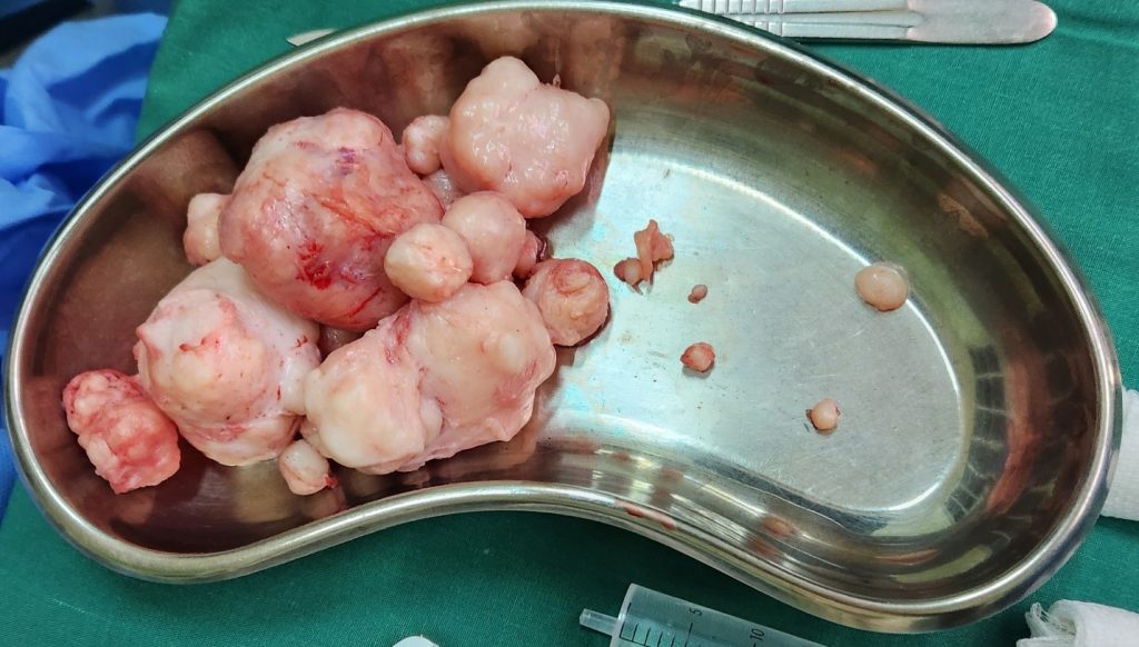 Fibroids